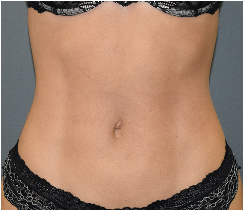 Her stomach after treatment with Vaser