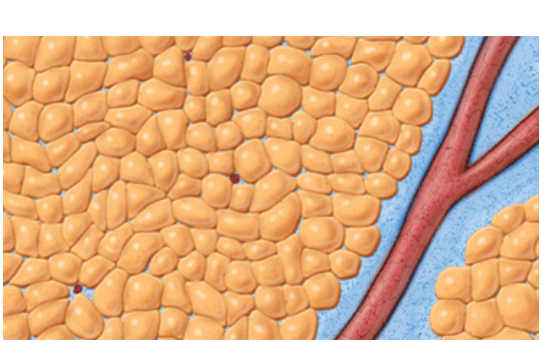 Vaser treatment during tumescent infusion