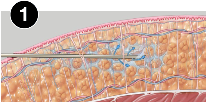 Vaser treatment during infiltration