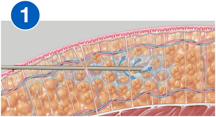 VASERlipo infiltration