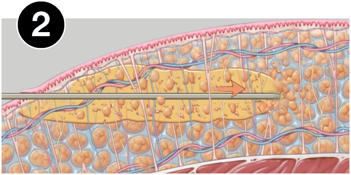 VASERlipo fragmentation