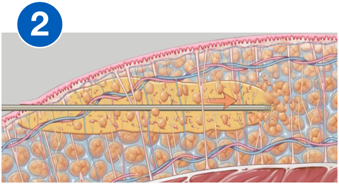 VASERlipo fragmentation