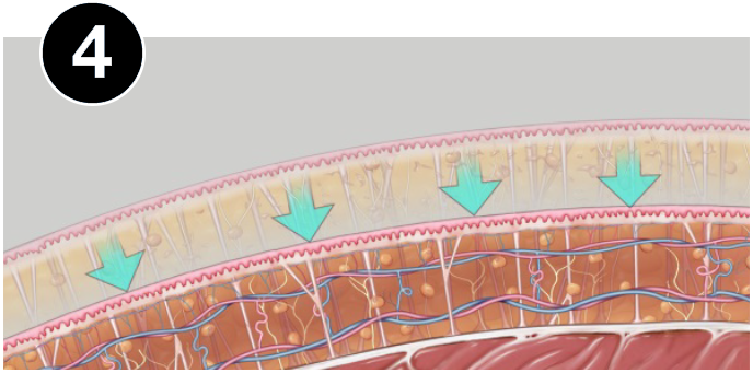 VASERlipo retraction