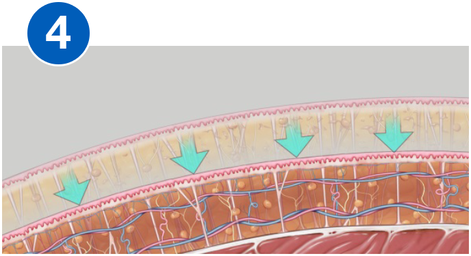 VASERlipo retraction