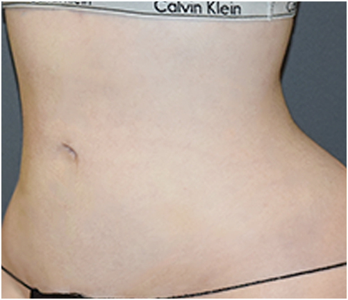 Her stomach after treatment with Vaser